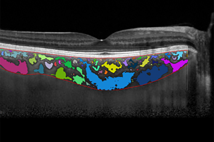 image of the retina generated by optical coherence tomography