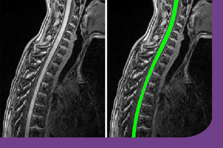 https://www.mssociety.org.uk/research/explore-our-research/search-our-research-projects/spinal-cord-imaging-people-ms