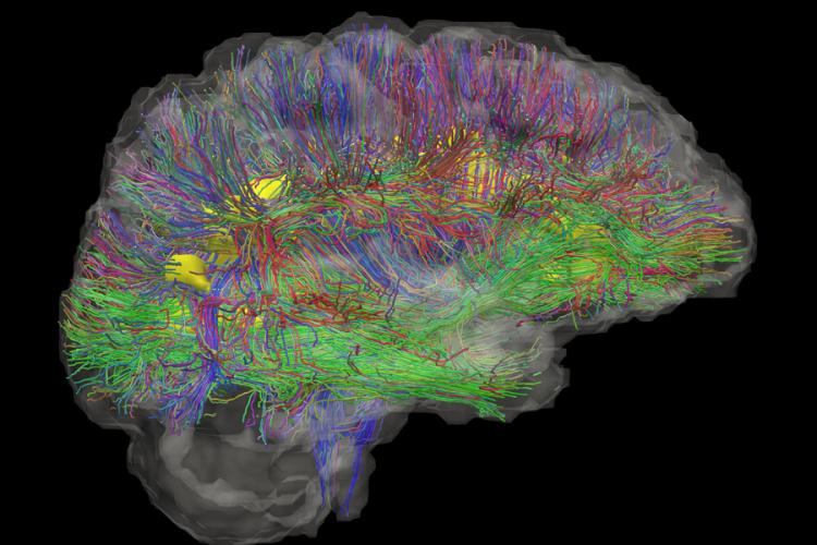 A brain with brain activity mapped in different bright colours