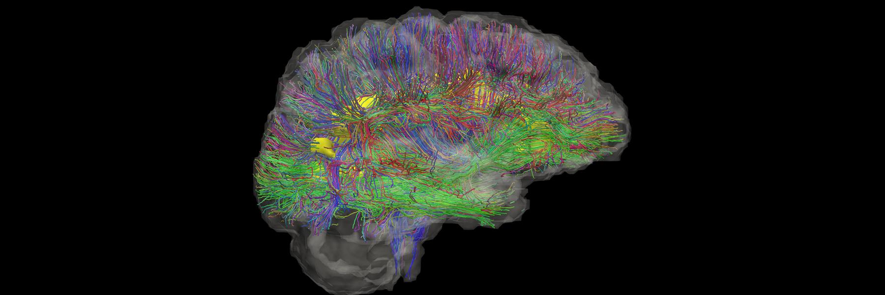 brain imaging showing white matter tracts