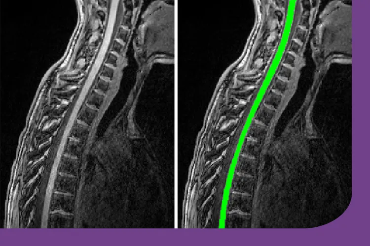 https://www.mssociety.org.uk/research/explore-our-research/search-our-research-projects/spinal-cord-imaging-people-ms